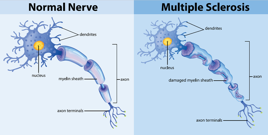 In a normal nerve, the sheath is not damaged. Here, bits of that sheath appear to have been eaten away.